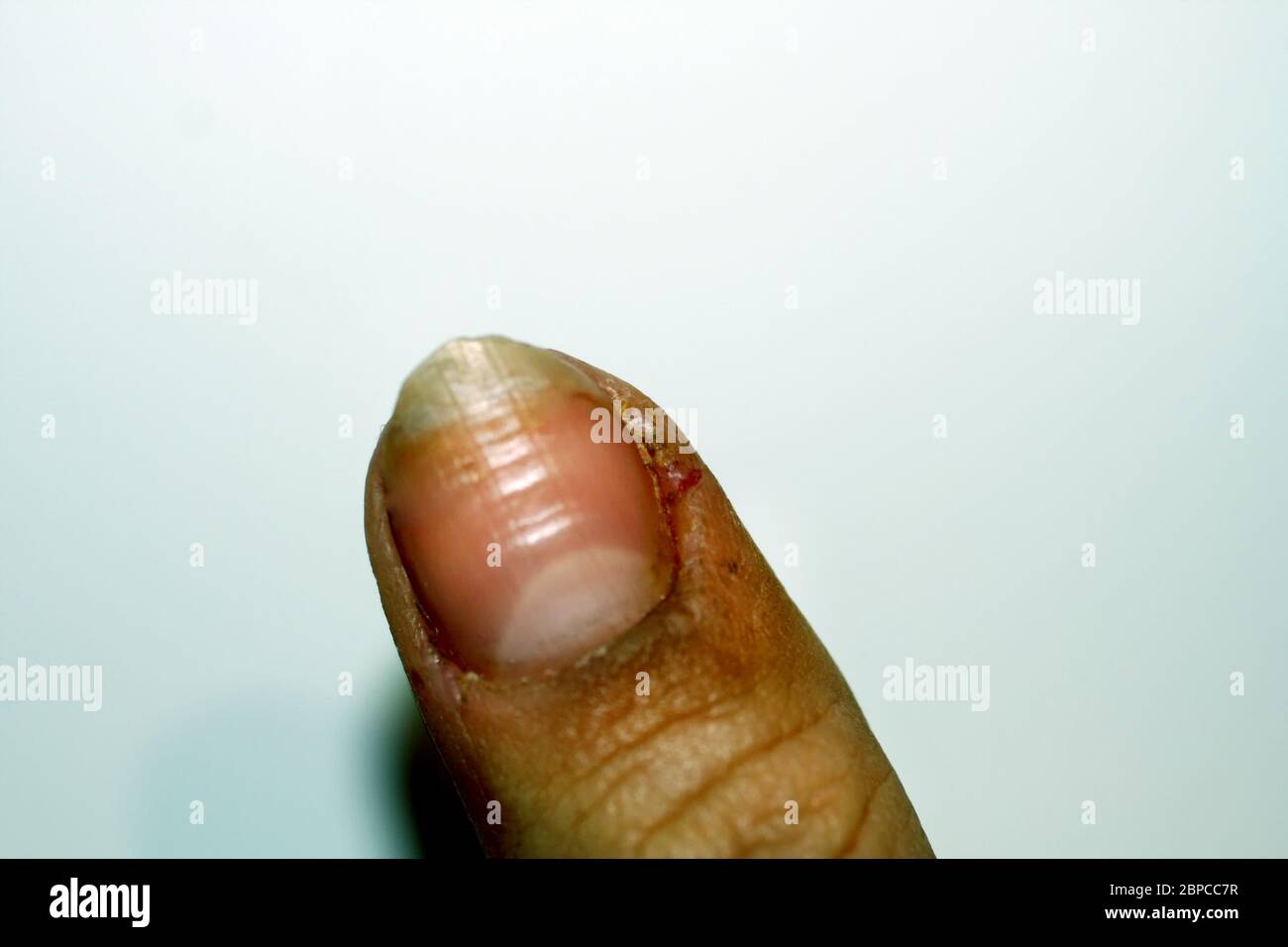 Burrs on the finger. Inflammation and abscess. Stock Photo