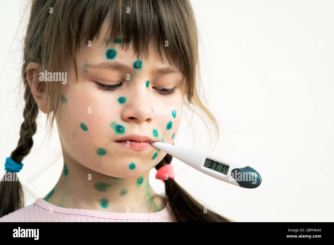 Child girl covered with green rashes on face ill with chickenpox, measles or rubella virus holding medical thermometer in her mouth having high temper Stock Photo