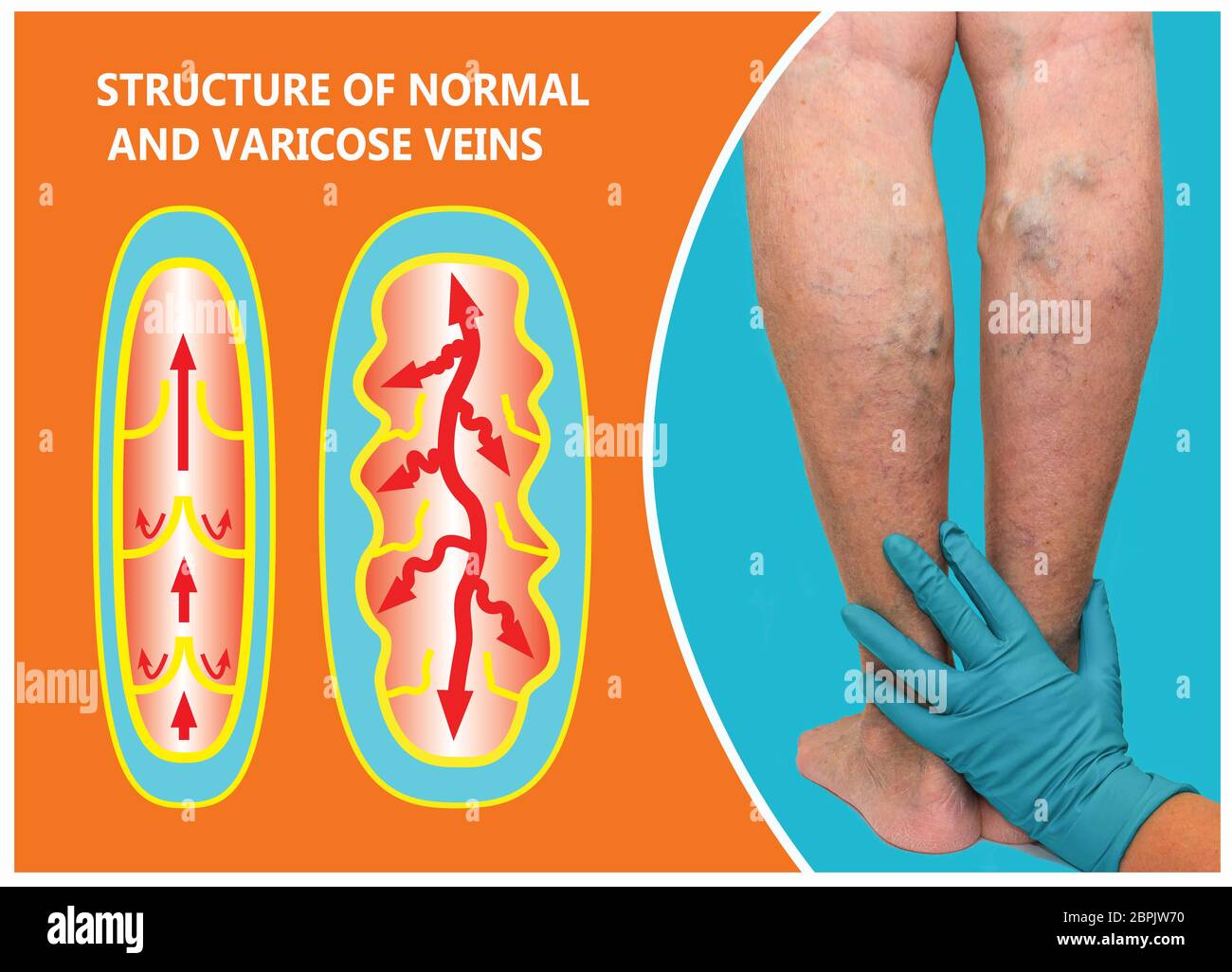 Varicose veins on a female senior legs. The structure of normal and