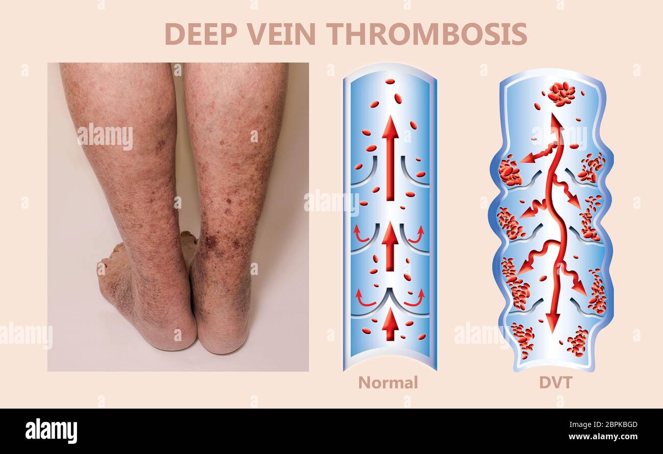 economy-class-syndrome-mechanism-deep-vein-thrombosis-or-dvt
