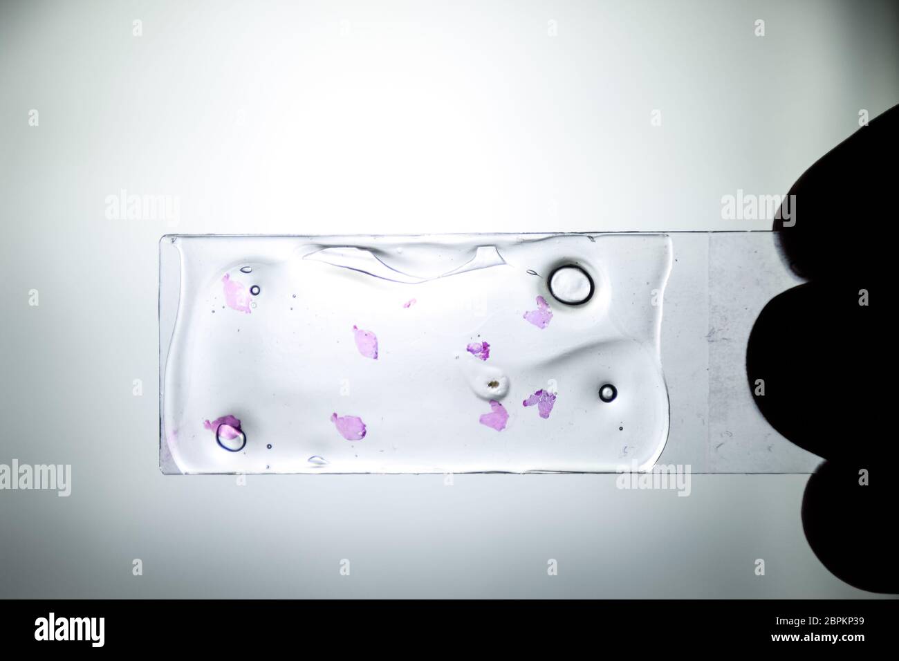 Slices of the tumor under glass. Histological examination of tumor