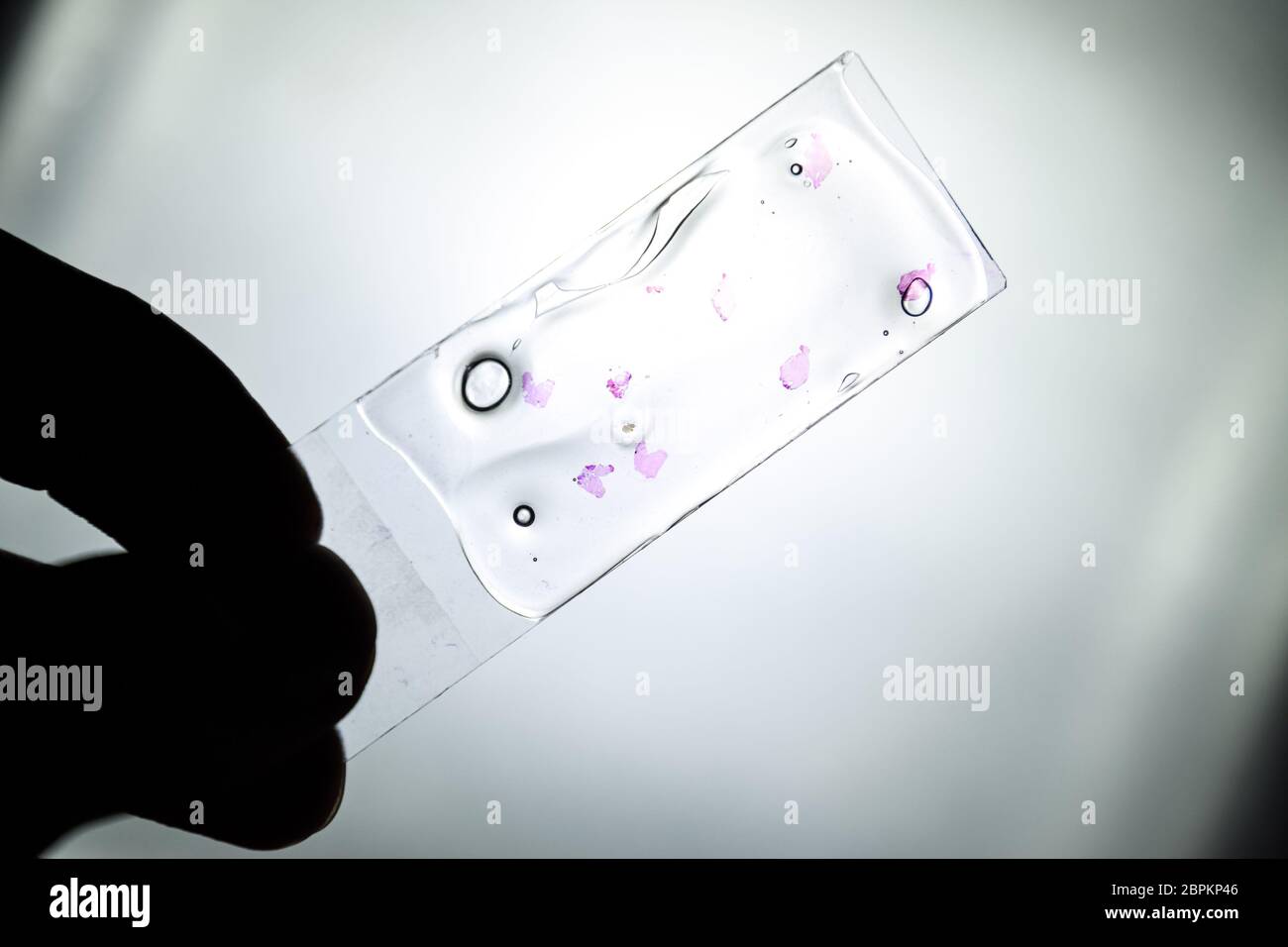 Slices of the tumor under glass. Histological examination of tumor