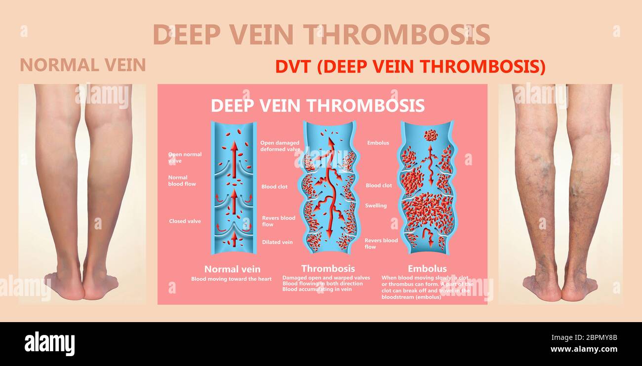 Deep Vein Thrombosis or Blood Clots. Embolus. Structure of normal and
