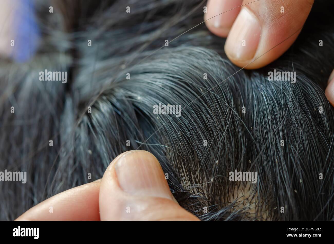 Head lice egg hair hi-res stock photography and images - Alamy