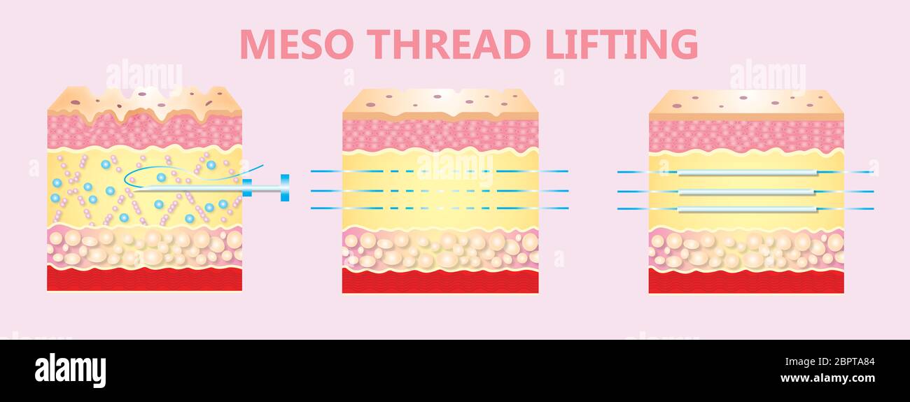 Meso thread Lift. Young and old skin. Lifting by threads concept Stock Photo Alamy
