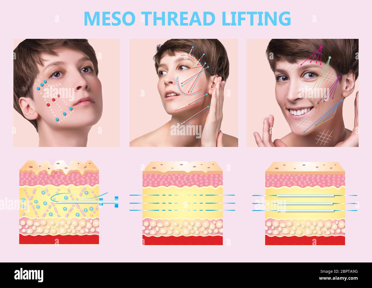 Meso thread Lift. Young female with clean fresh skin. Beautiful woman. face and neck. Lifting by
