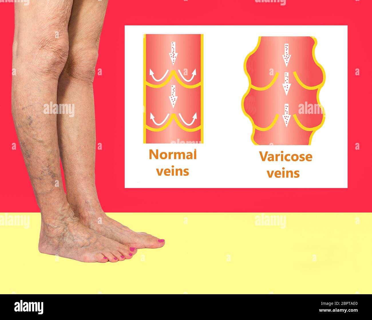 Varicose veins on a female senior legs. The structure of normal and