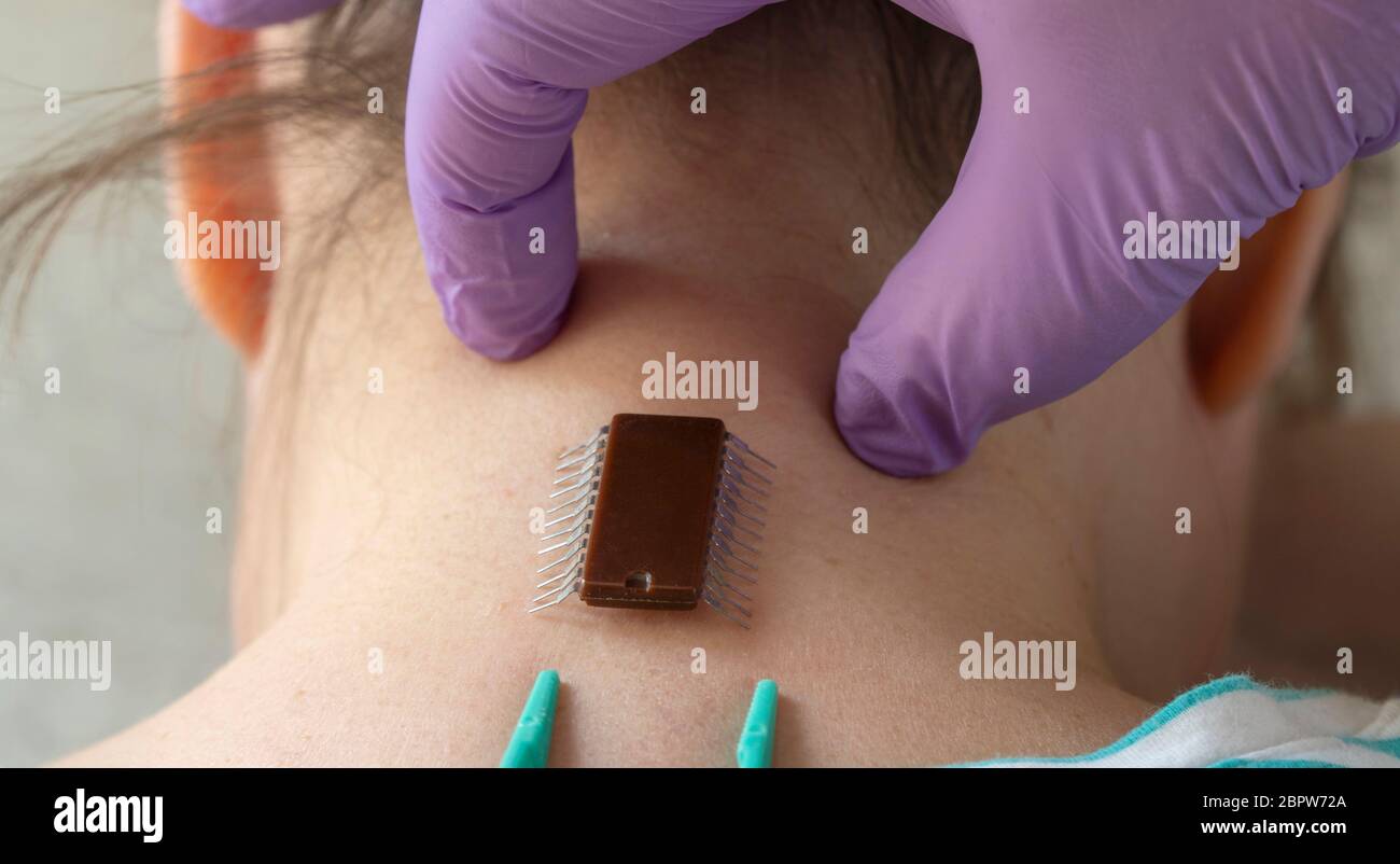 implantation of chip under the human skin. microchip is connected to