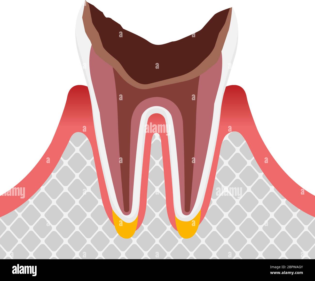 The stage of tooth decay / Dead tooth Stock Vector