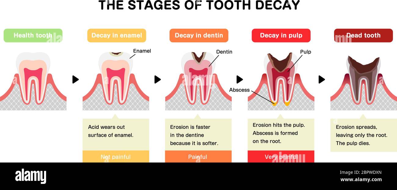 The stages of tooth decay / flat vector illustration Stock Vector