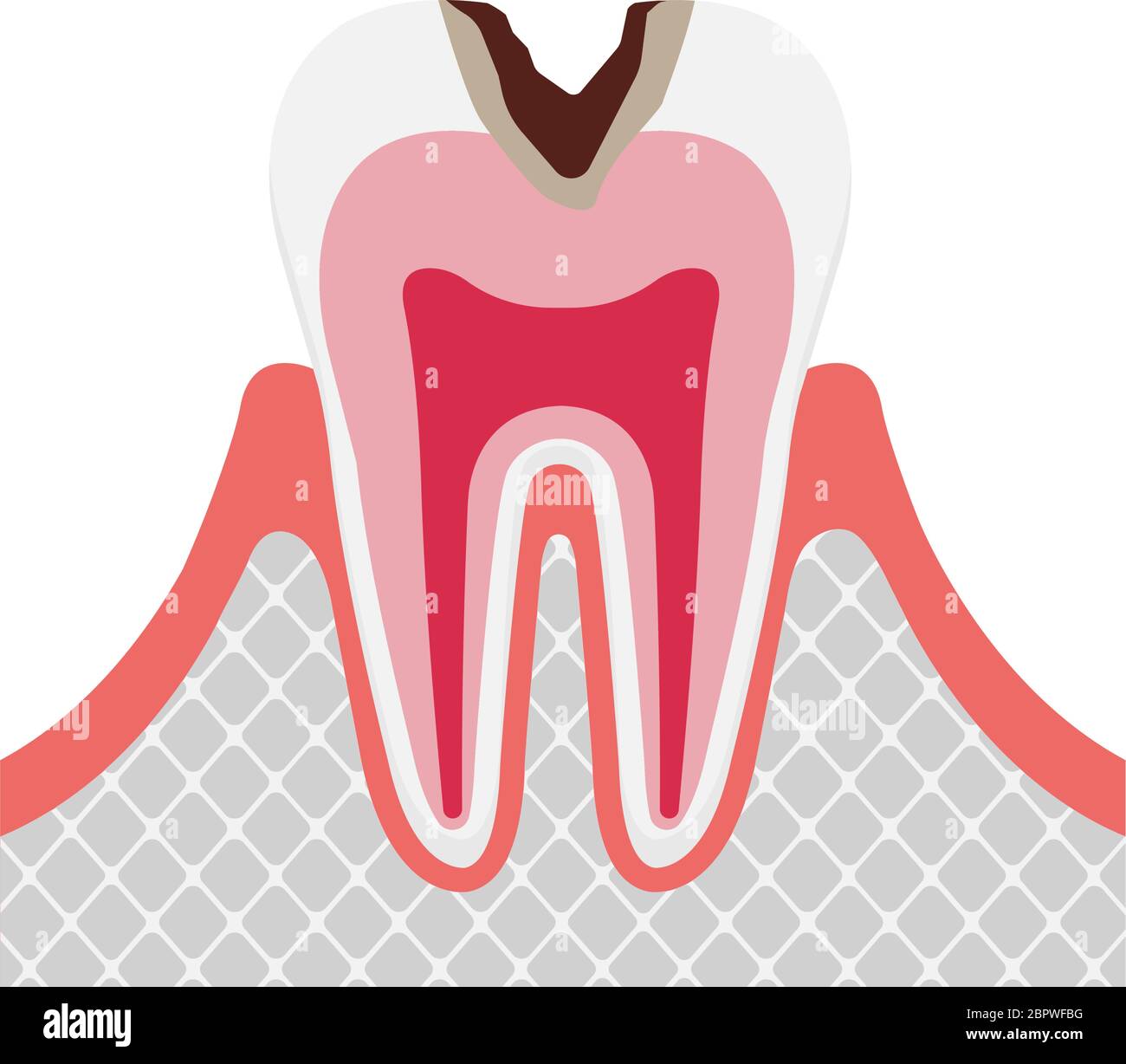 The stage of tooth decay / Decay in dentin Stock Vector