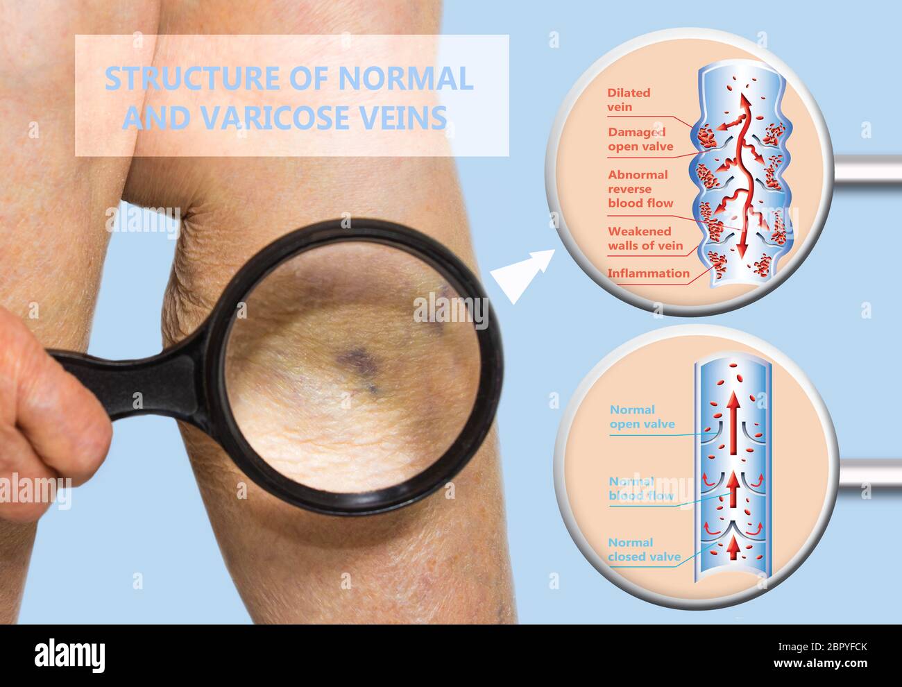 Varicose veins on a female senior legs. The structure of normal and