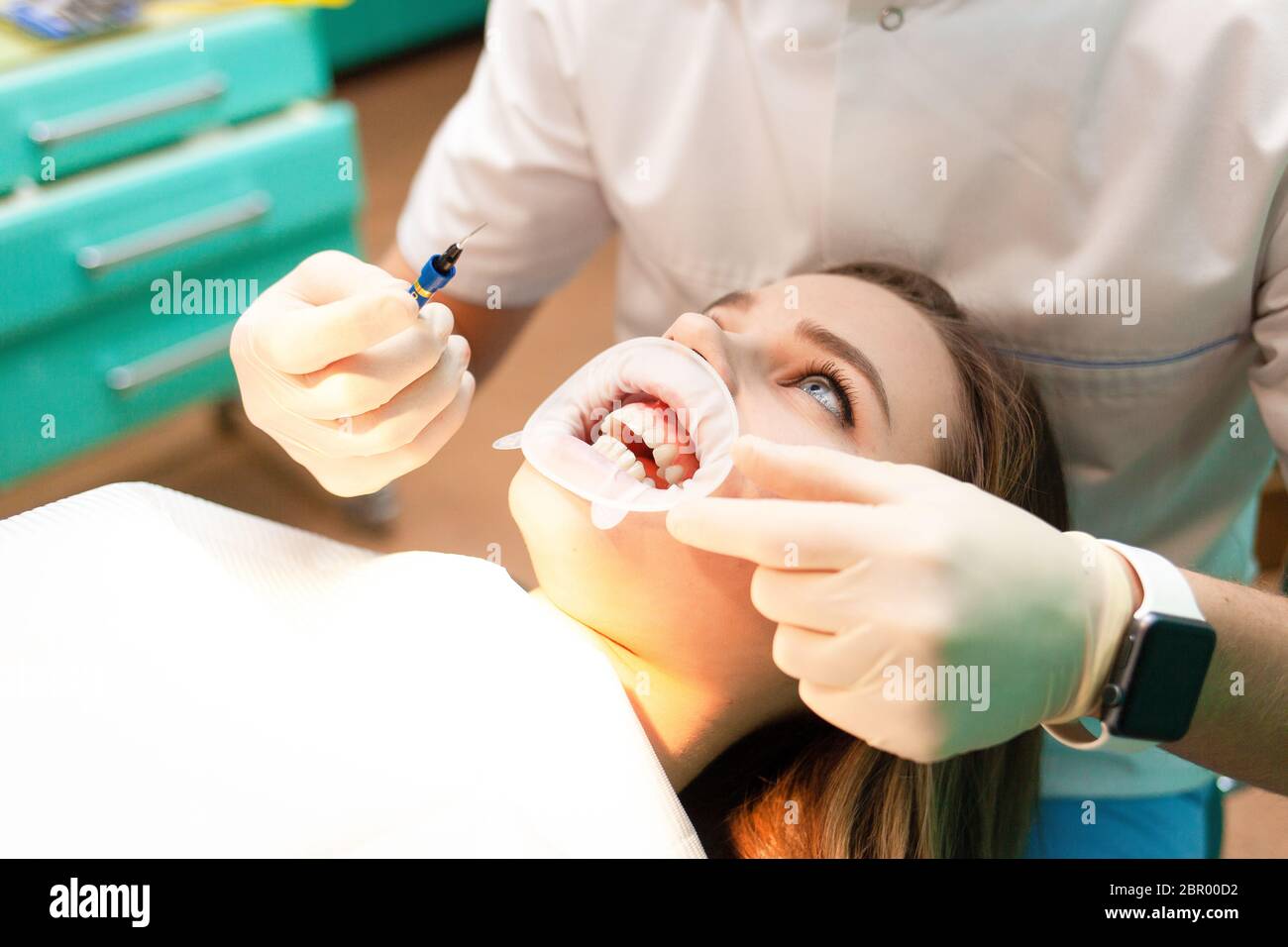 Dental cheek retractor hires stock photography and images Alamy