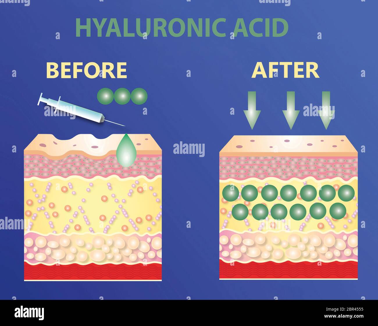 Hyaluronic acid. skin-care products. skin rejuvenation with help of hyaluronic acid. Lifting by filler concept Stock Photo