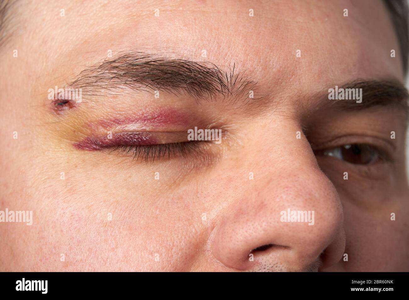 close view of a bruise near the eye, the face of a man with a hematoma  Stock Photo - Alamy