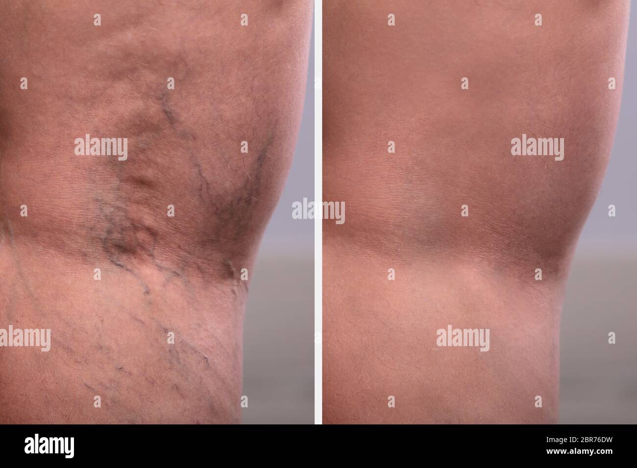 A Person Knee's With Varicose Veins And Capillaries Before And After