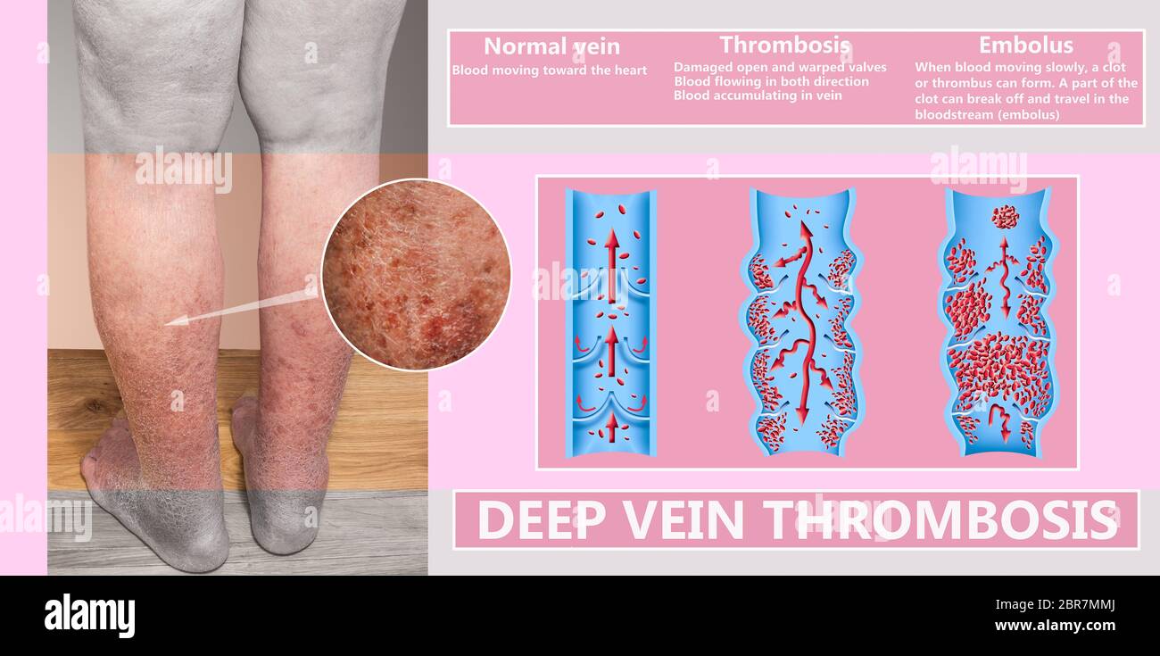 Deep Vein Thrombosis or Blood Clots. Embolus. Structure of normal and