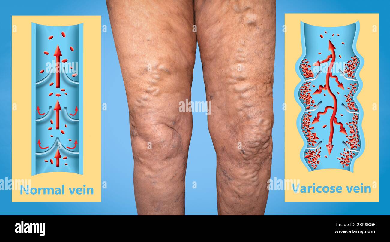 Varicose vein on a female senior legs. The structure of normal and