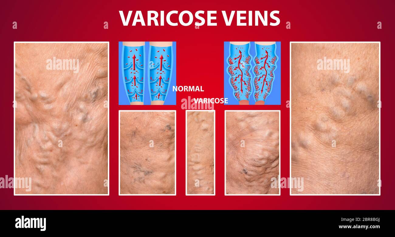 The old age and sick of a woman. Varicose veins on a legs of woman. The ...