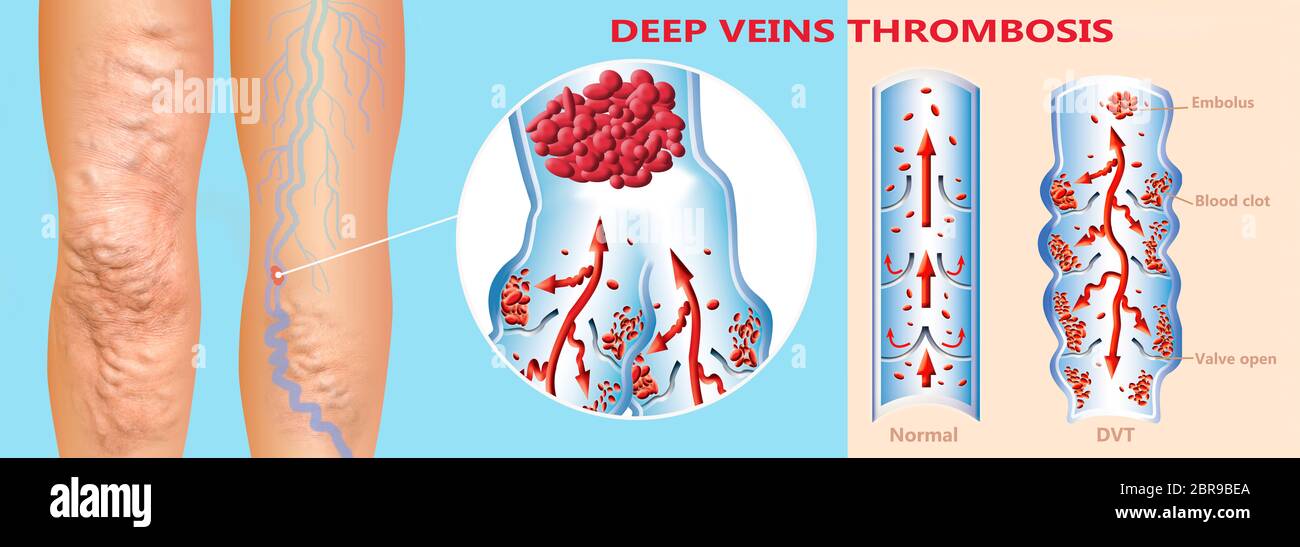 Deep Vein Thrombosis or Blood Clots. Embolus. Structure of normal and