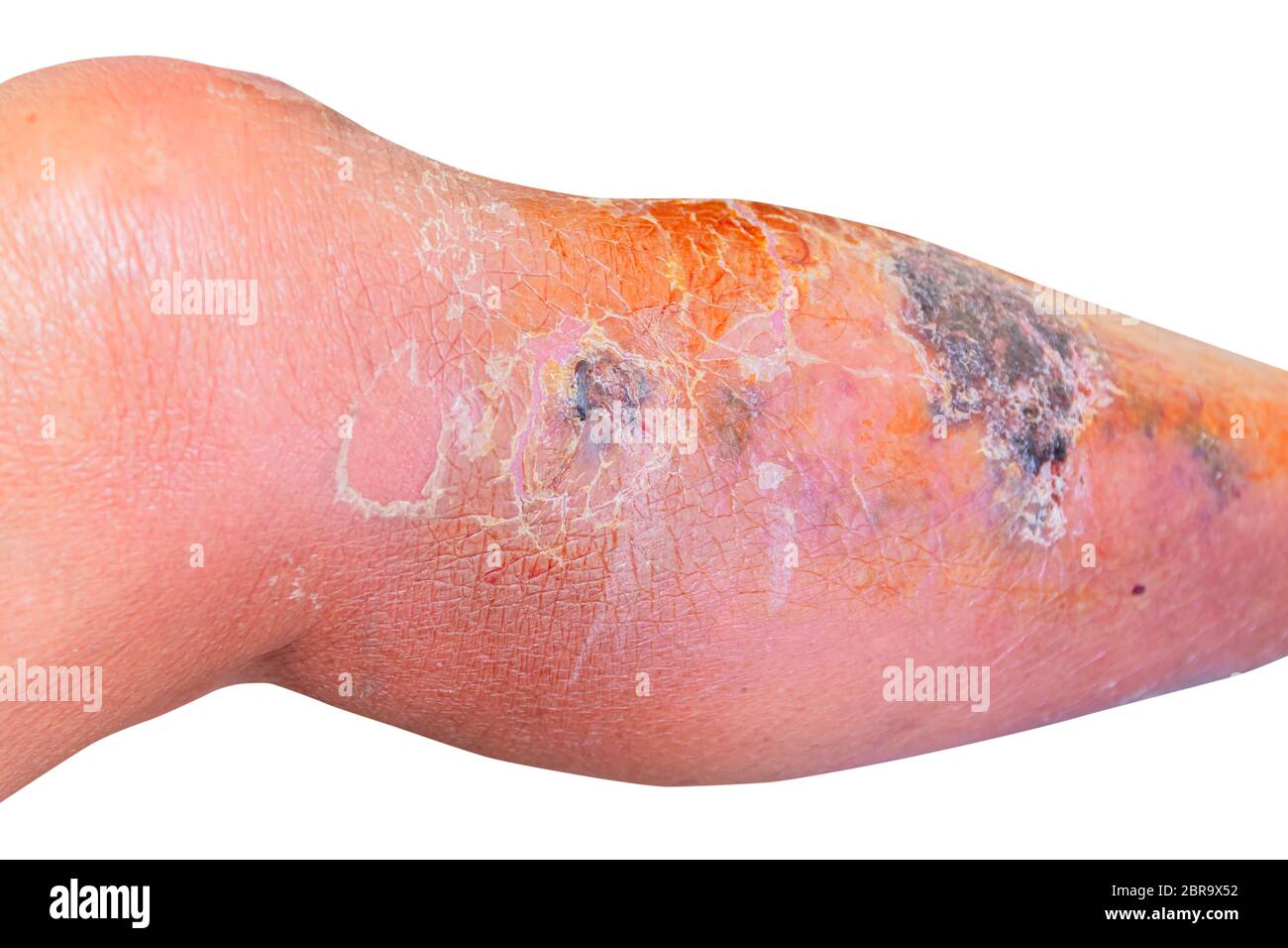 Erysipelas bacterial infection Under the skin leg aged people On  white background Stock Photo