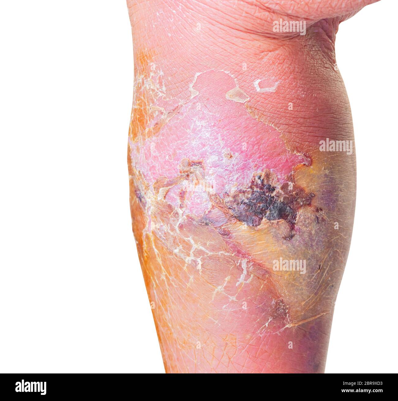 Erysipelas bacterial infection Under the skin leg aged people On  white background Stock Photo
