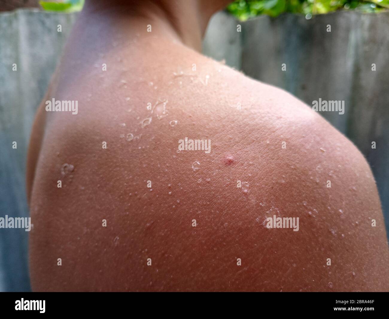 Exfoliation of the skin after sunburn. Excessive tan. The effects of sunburn on the skin. Climb skin. Stock Photo