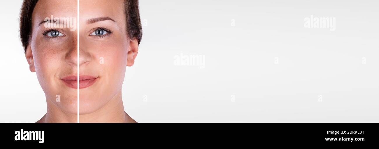 Before After Laser Face Microdermabrasion. Woman Cosmetic Treatment