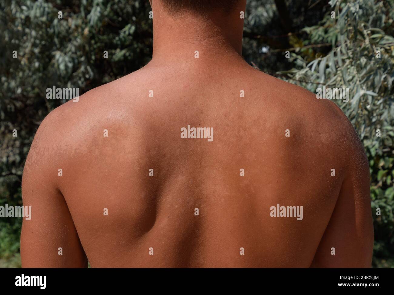 Sunburn on the skin of the back. Exfoliation, skin peels off. Dangerous sun  tan Stock Photo - Alamy