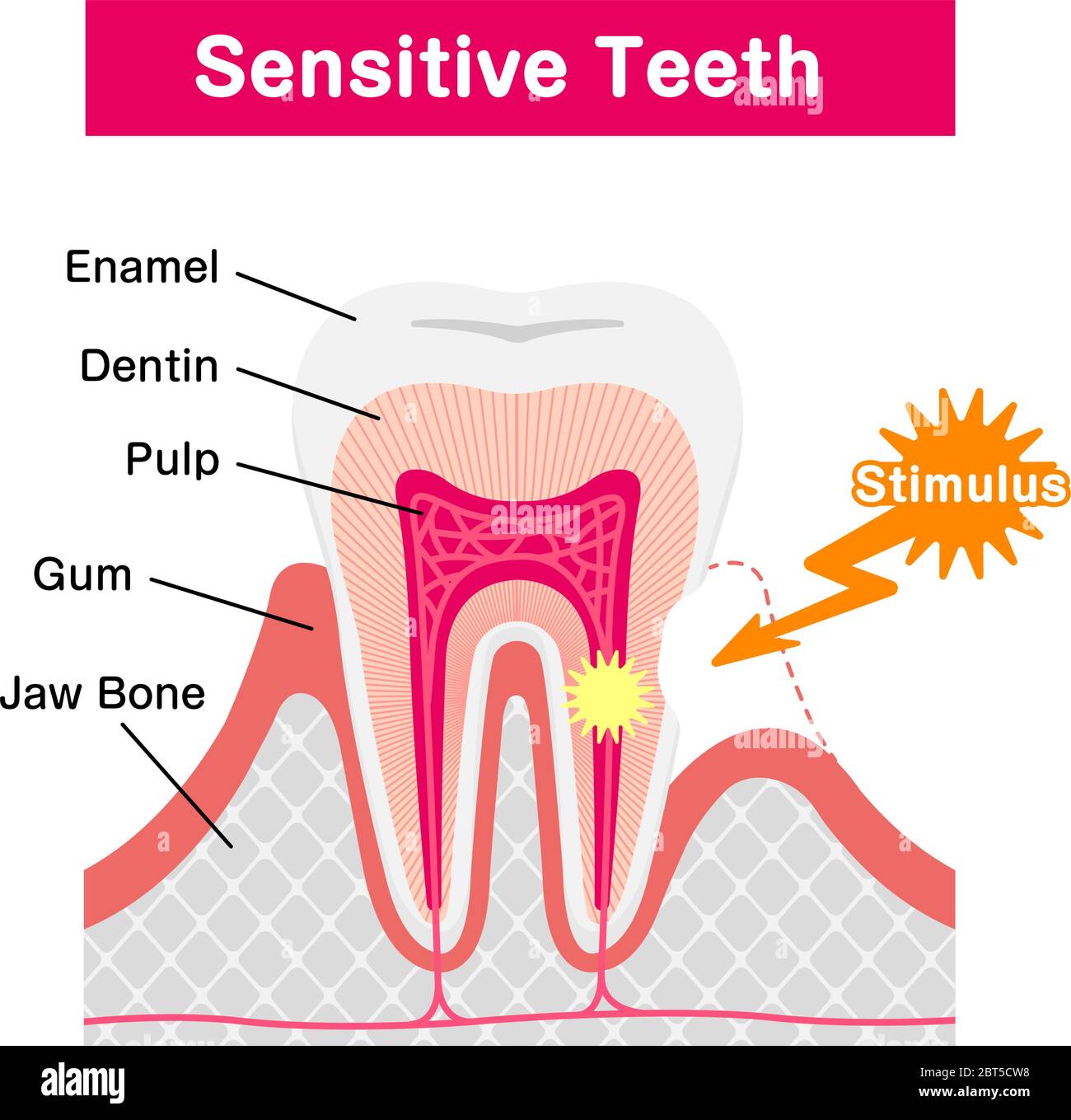 Cause and mechanism of Sensitive teeth vector illustration Stock Vector