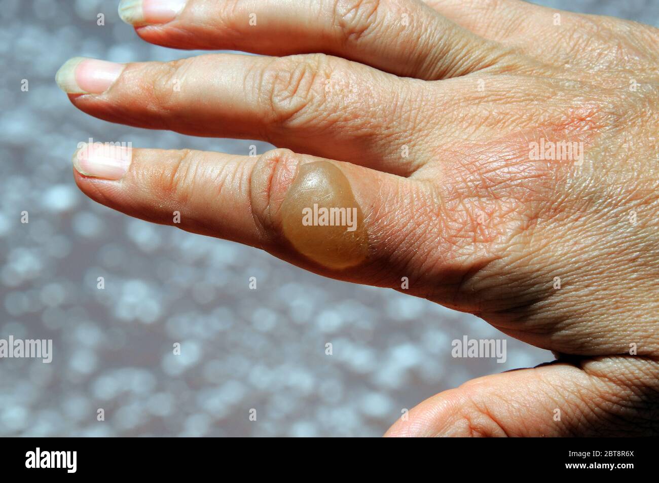 Large blister on womans hand caused by boiling water scald Stock Photo