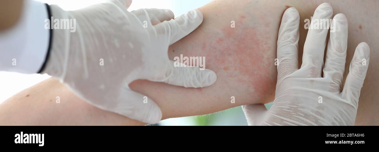 Exam Rash Close-up examination by doctor, allergic rash Stock Photo - Alamy