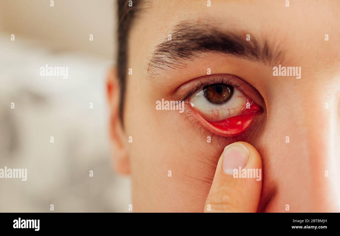 Infected sty barley purulent eye. Man pulls down lower eyelid showing inflammation pus caused by Staphylococcus. Stock Photo