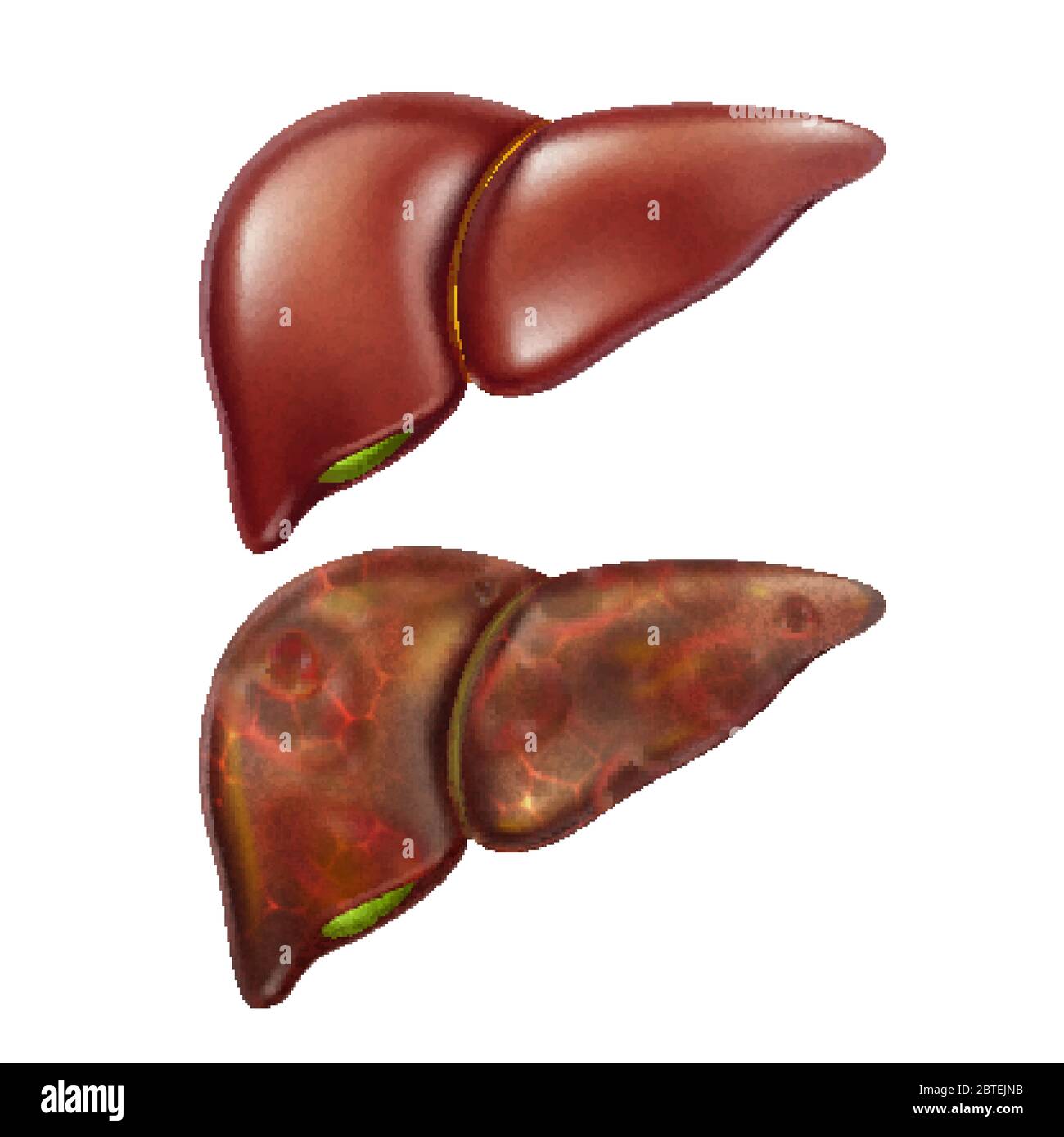 Unhealthy Liver