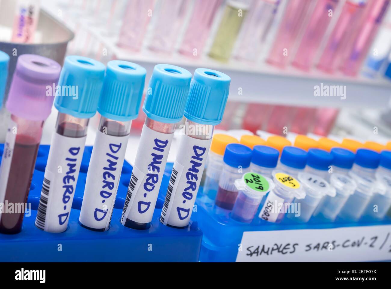 Blood samples with high levels of dimero-D from Sars-Cov-2 infected patients in a laboratory, conceptual image Stock Photo