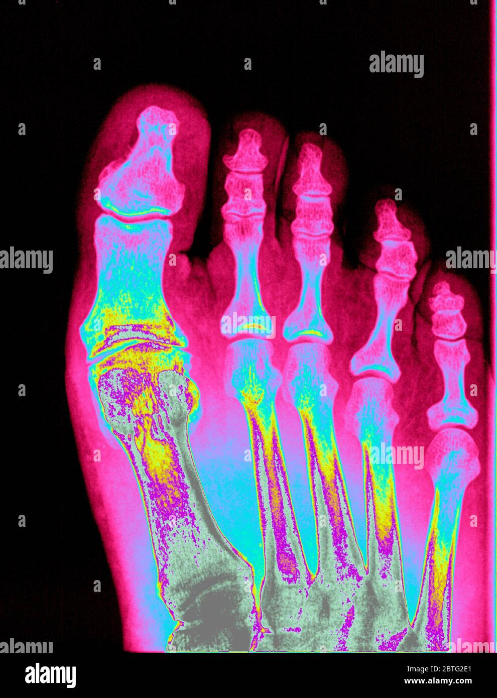 Coloured x-ray, foot Stock Photo - Alamy