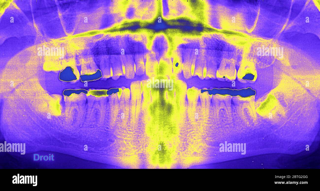 Teeth, Coloured XRay Stock Photo Alamy