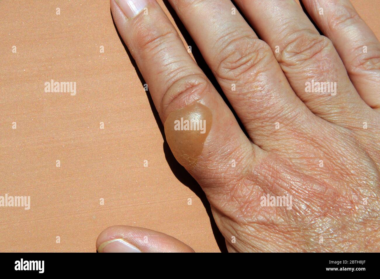 Large blister on woman’s hand caused by boiling water scald. Stock Photo