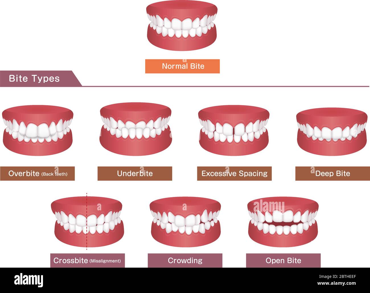 Teeth trouble ( bite type ) vector illustration set Stock Vector Image ...