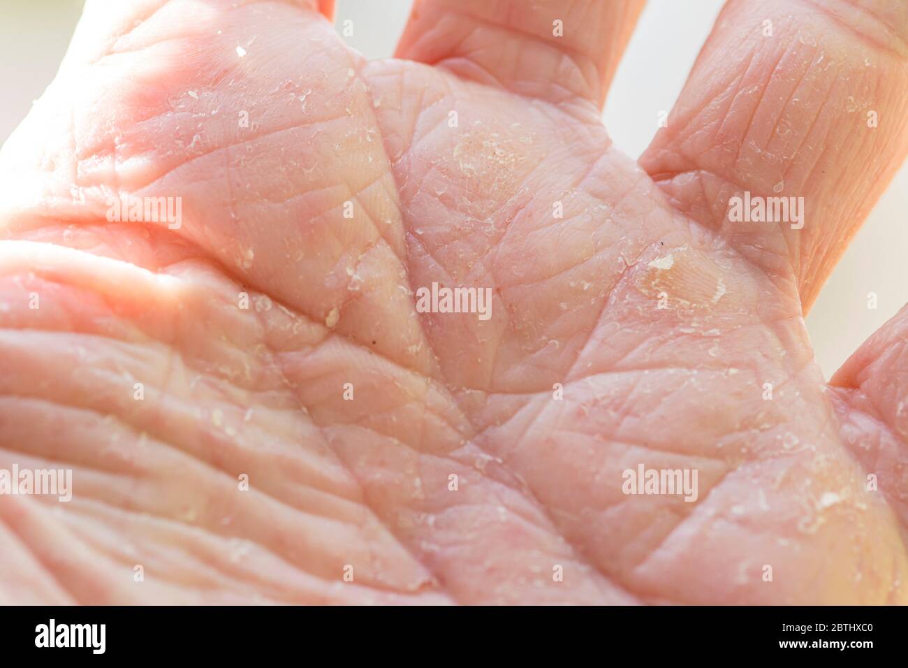 Skin eczema on the hand of a man with scaly skin Stock Photo