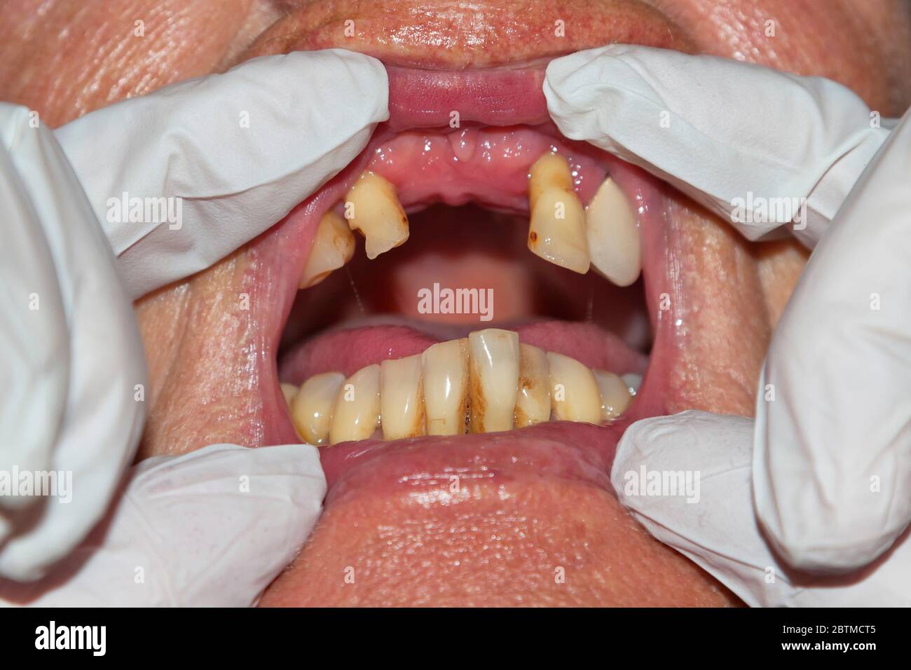 Elderly woman with tooth gaps, symbolic image for poverty in old age Stock Photo