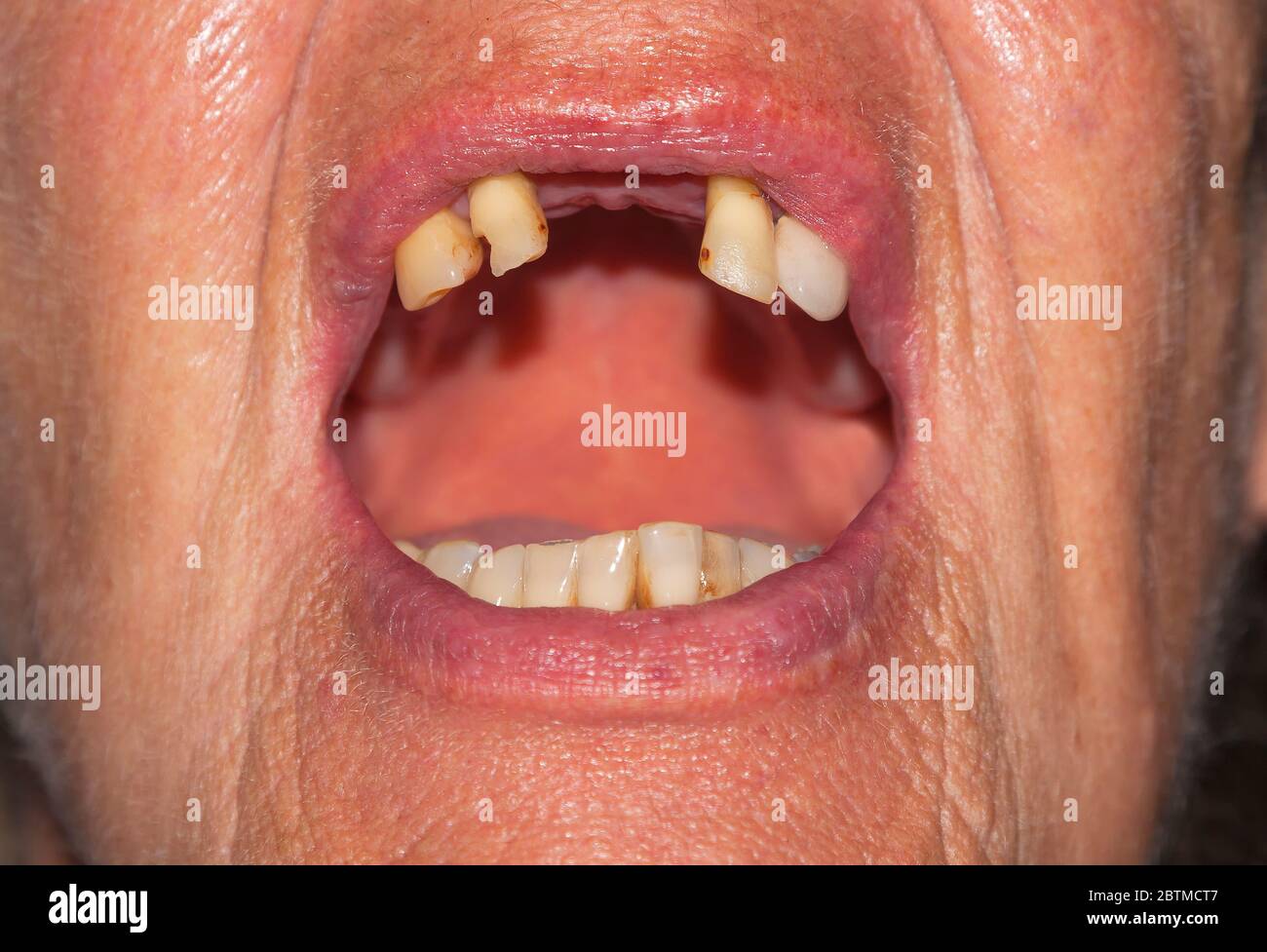 Elderly woman with tooth gaps, symbolic image for poverty in old age Stock Photo