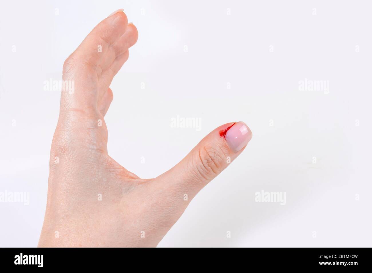 Bleeding hangnail closeup female hand injury. Bad habits, biting and ...