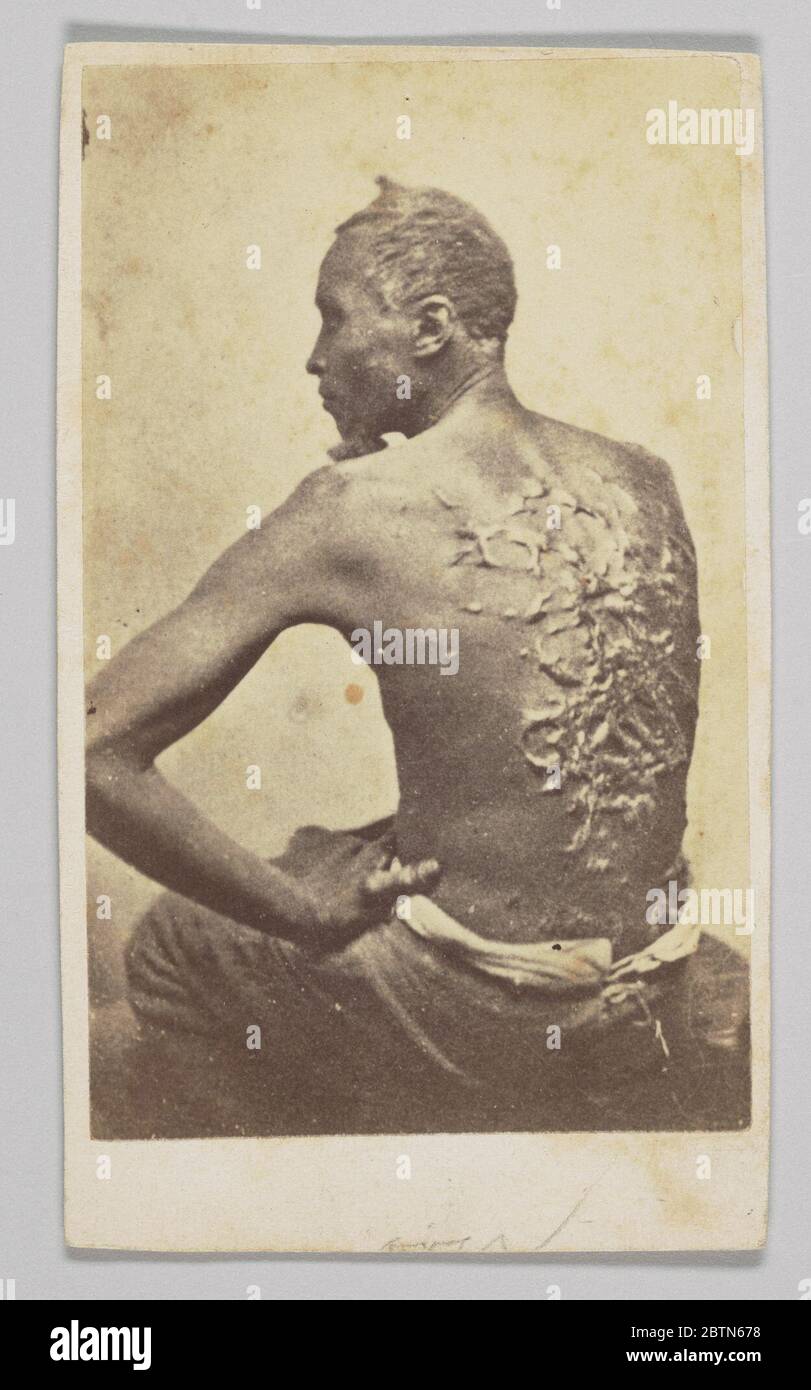 Gordon Under Medical Inspection. Carte-de-visite of a formerly enslsaved man identified only as Private Gordon. Gordon is seated wearing trousers and no shirt. Facing the camera is his bare back, with severe raised scars from just above his shoulder blades to his lower back. Stock Photo