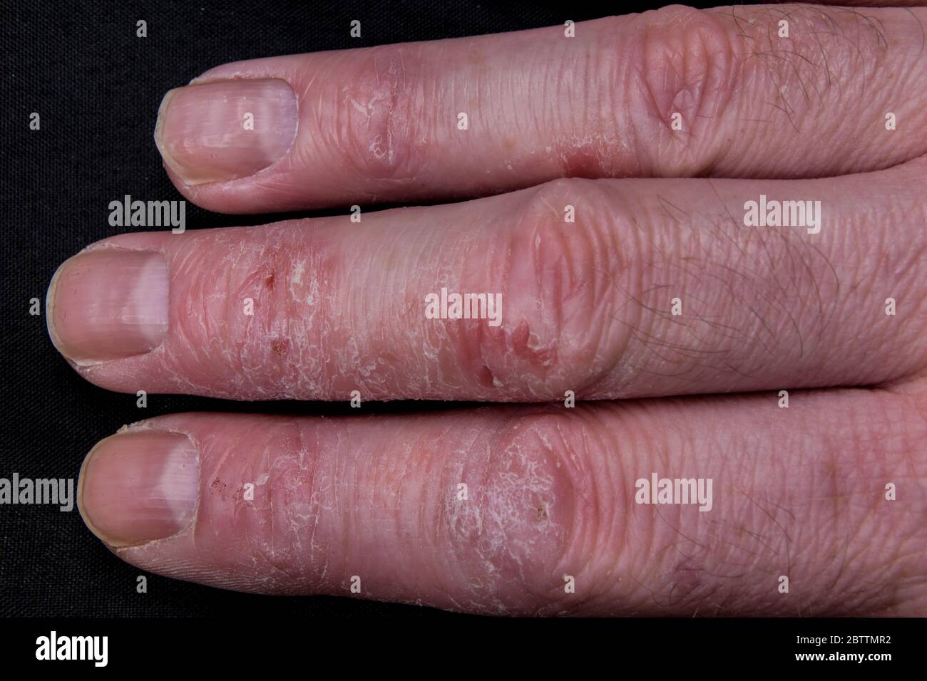 3 Fingers with dry flaking skin and eczema Stock Photo