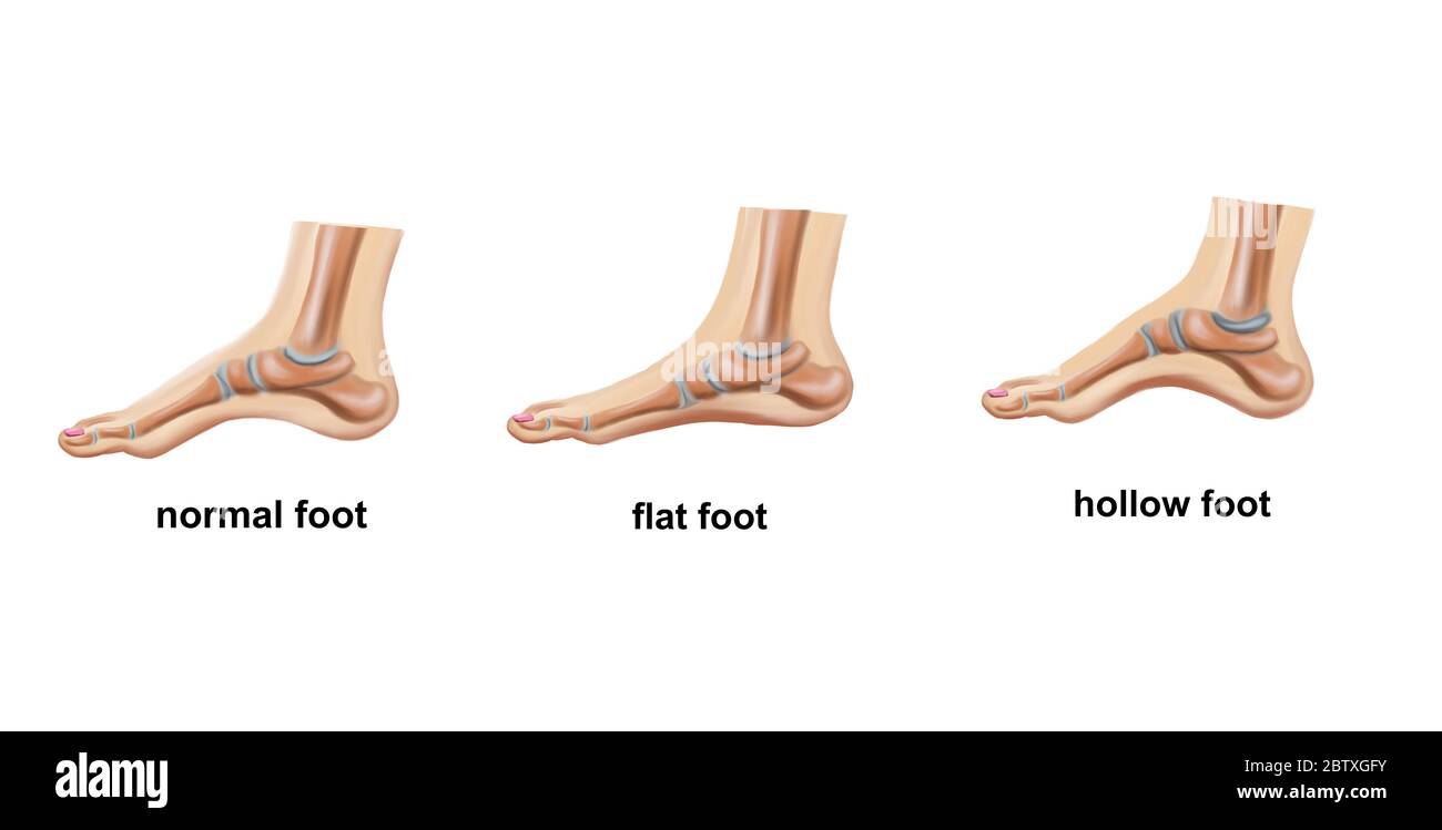 Medical illustration of the flat foot Stock Photo