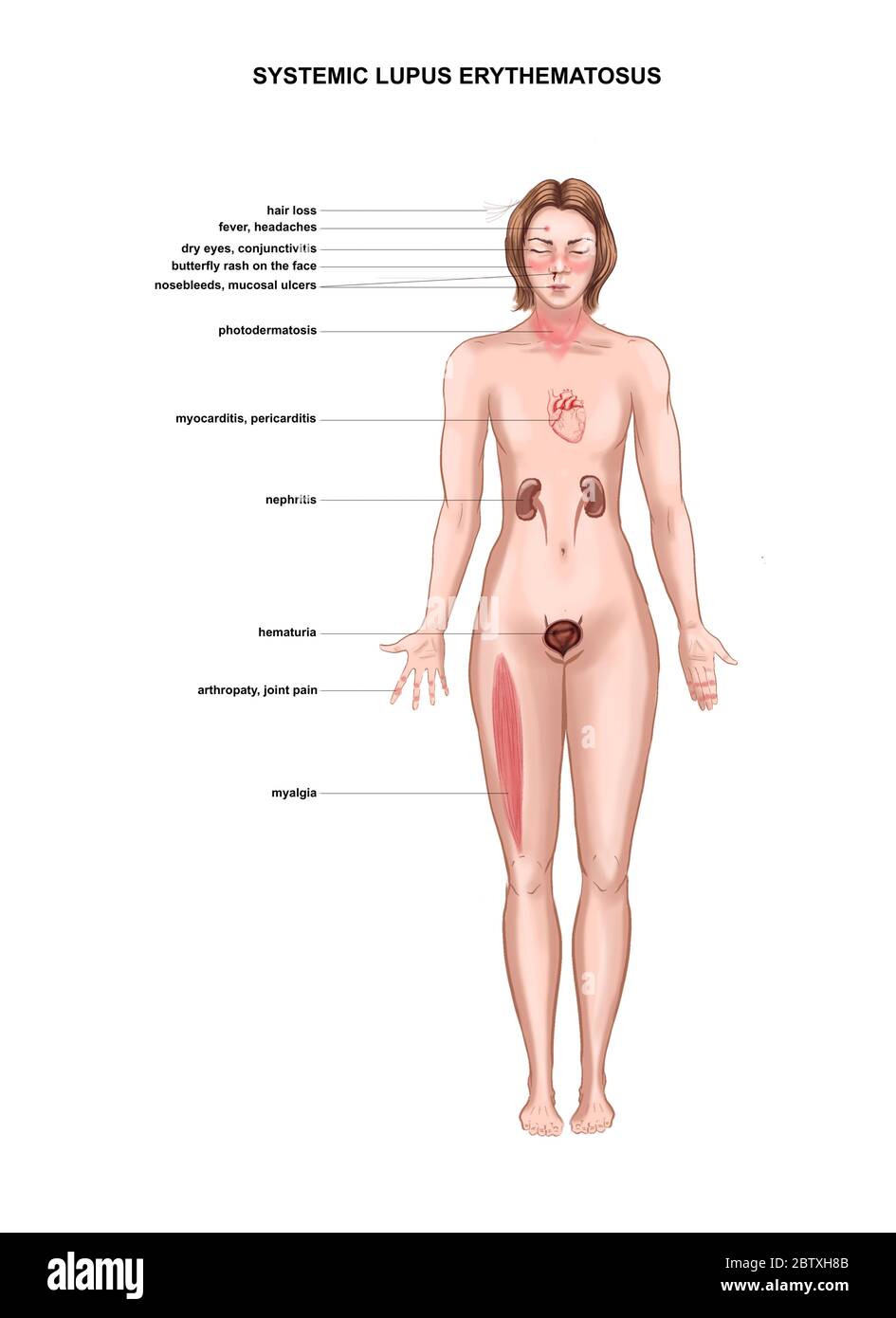 Medical illustration of symptoms of systemic lupus erythematosus Stock Photo