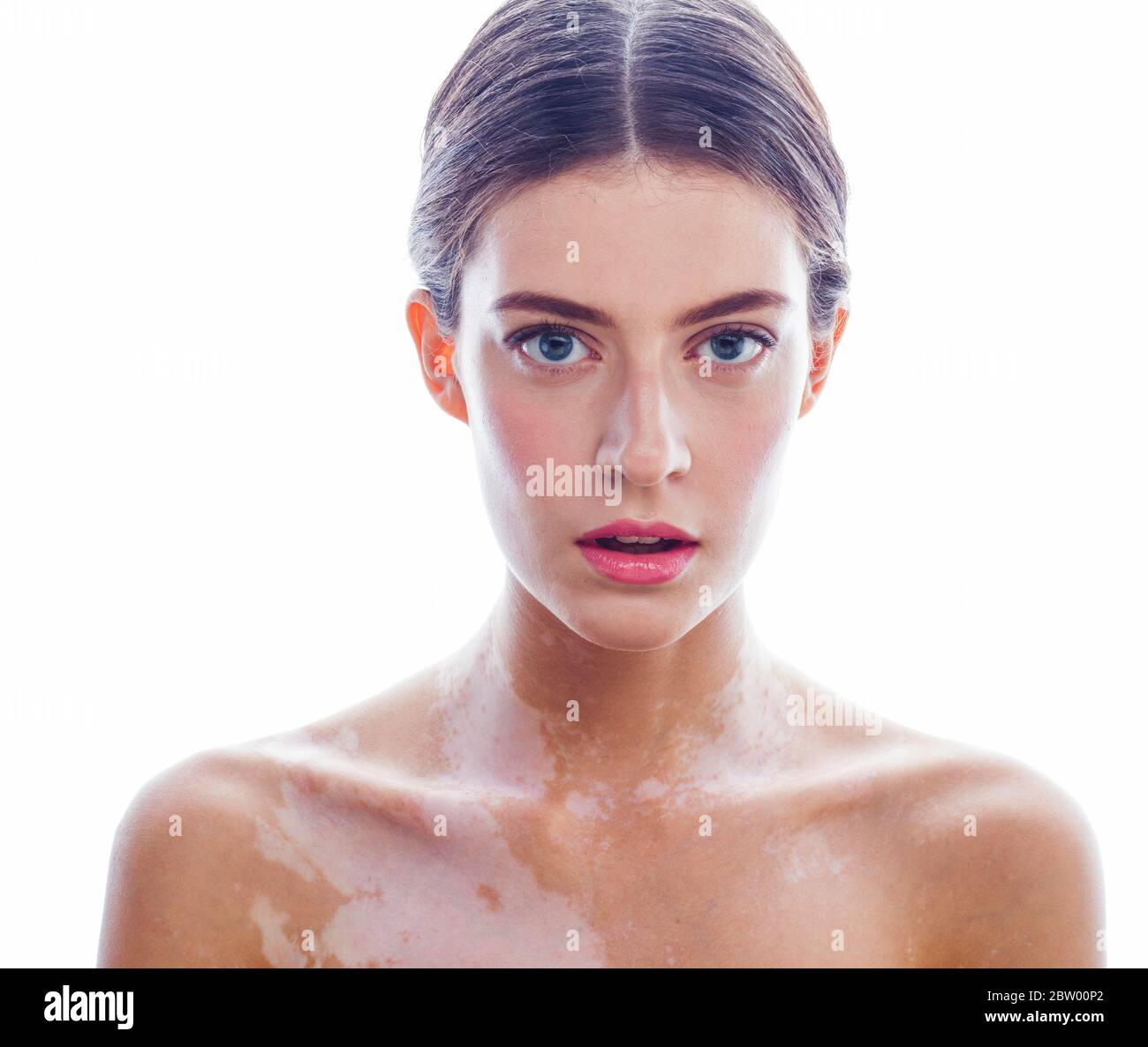 beautiful young woman with vitiligo disease isolated on white positive smiling, model