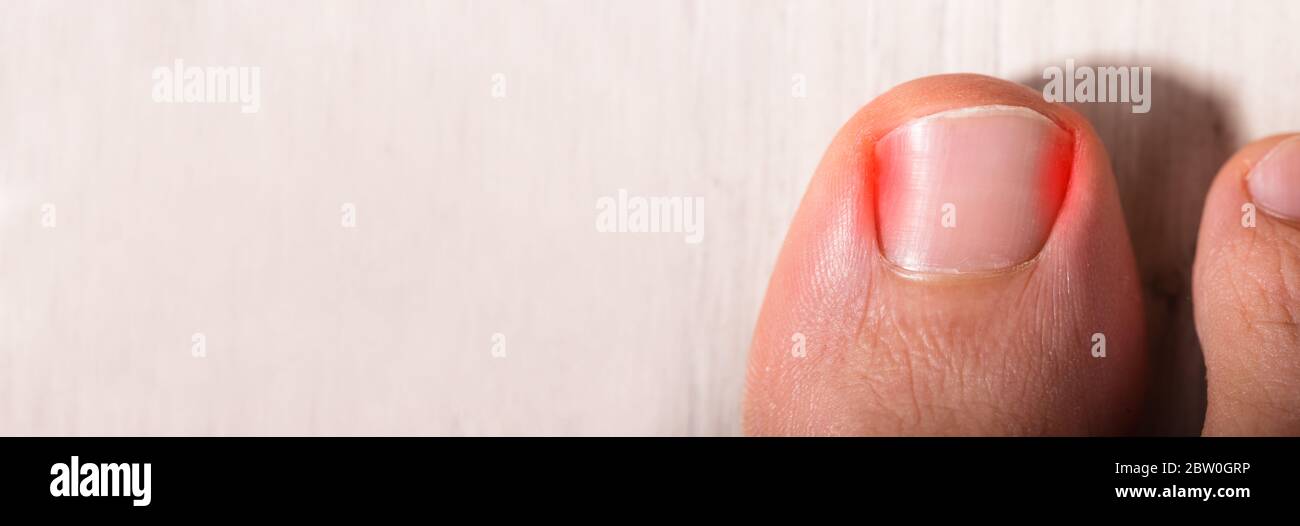 Ingrown Toenail Problem. Sore Nail And Painful Toe Stock Photo - Alamy
