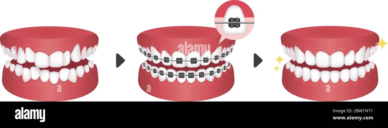 Dental braces process vector illustration / no text Stock Vector Image ...